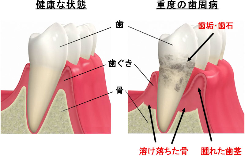 歯周病